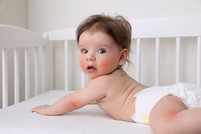 Common Skin Issues In Babies And How To Prevent Them